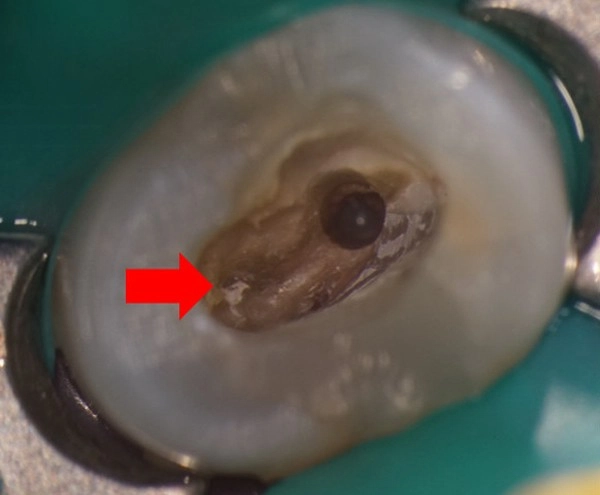 顯微根管-根管鈣化案例