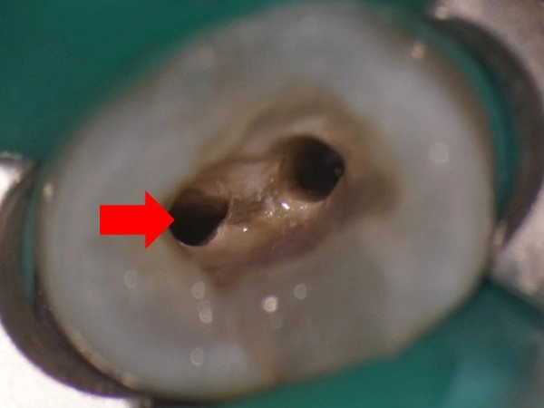 顯微根管-根管鈣化案例