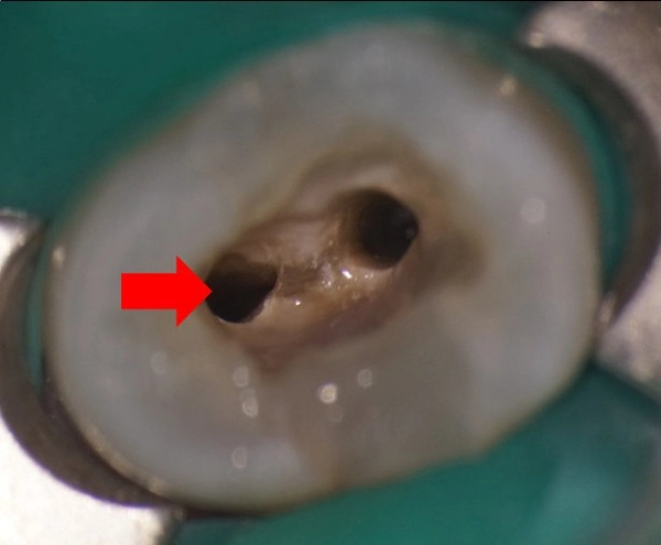 顯微根管-根管鈣化案例