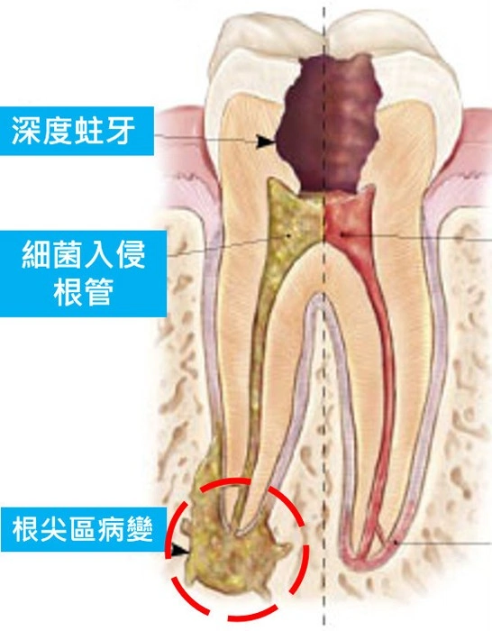 顯微根管-根尖區病變案例