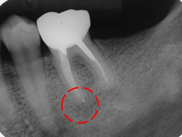 顯微根管-根尖區病變案例