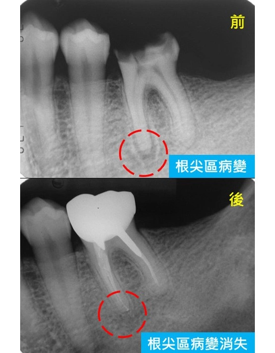顯微根管-根尖區病變案例