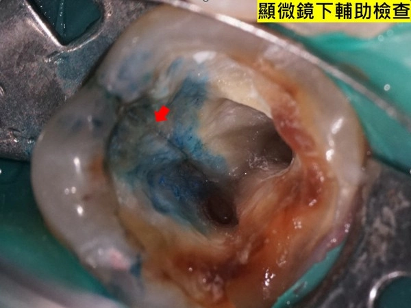 顯微鏡下輔助檢查-牙齒裂痕檢查