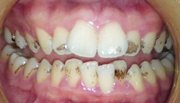 噴砂美白案例一