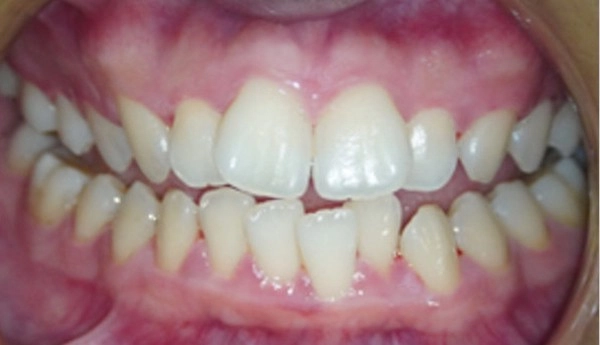 噴砂美白案例一