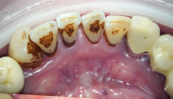 噴砂美白案例二