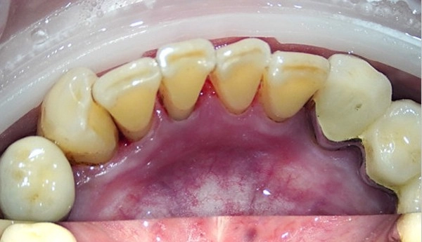 噴砂美白案例二