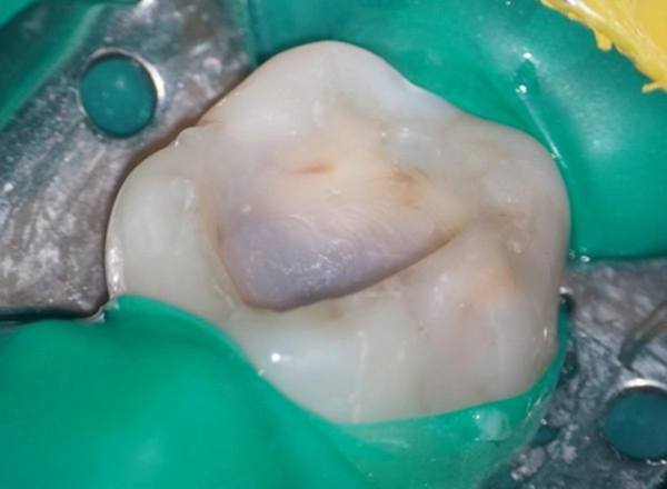 陶瓷嵌體/3D齒雕案例一