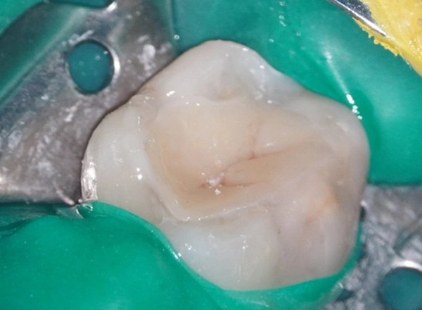 陶瓷嵌體/3D齒雕案例一