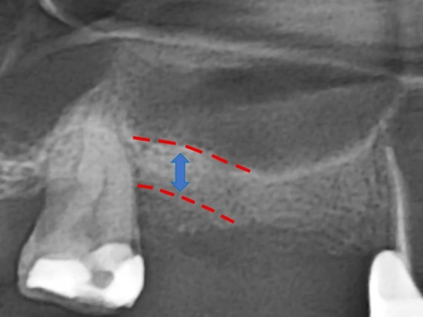 鼻竇增高術案例二