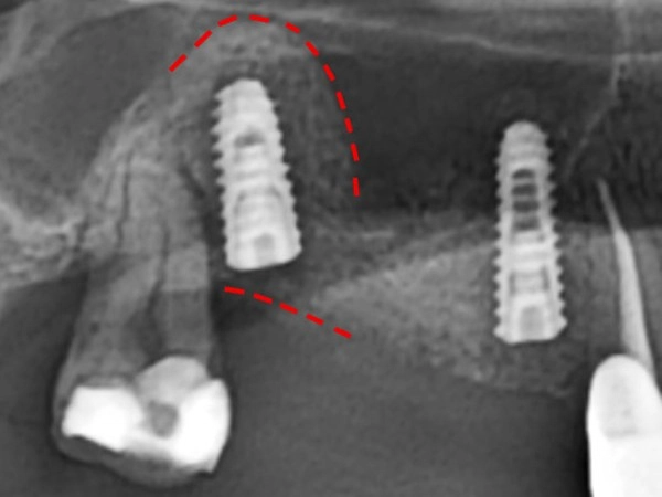 鼻竇增高術案例二