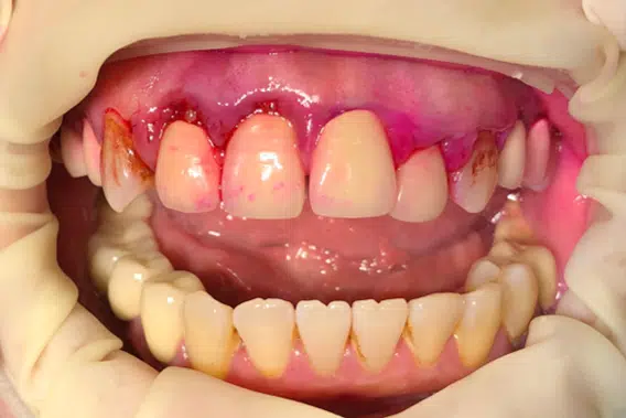 水雷射牙周治療案例