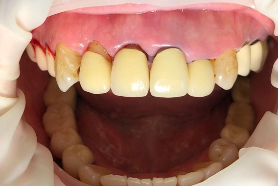 水雷射牙周治療案例